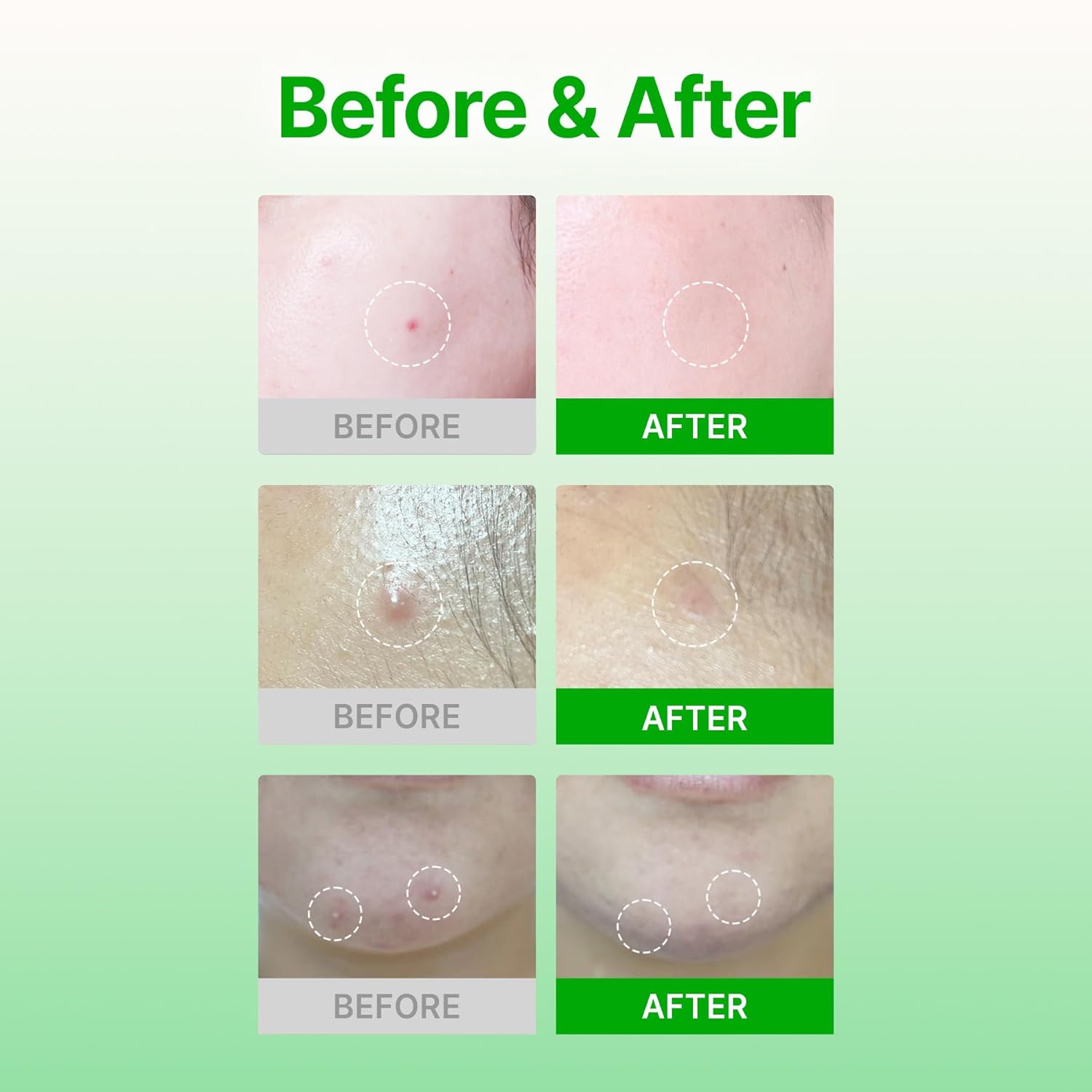 ACROPASS Trouble Care Patch